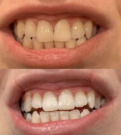Before and after white teeth